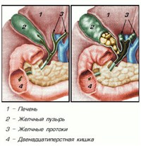 Желчнокаменная болезнь