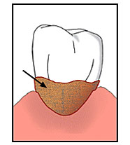 ЗУБНОЙ КАМЕНЬ