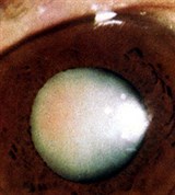 Зрелая старческая Катаракта