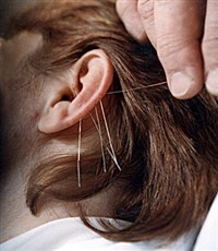 ИГЛОУКАЛЫВАНИЕ