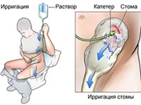 ИРРИГАЦИЯ СТОМЫ