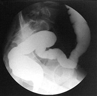 ИРРИГОСКОПИЯ (рентген)