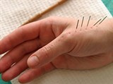 Иглоукалывание (приемы на руке)