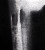 Изменения в костях при гиперпаратиреозе