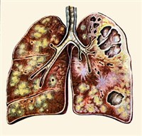 Изменения в легких при туберкулезе