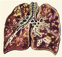 Изменения легких при силикозе
