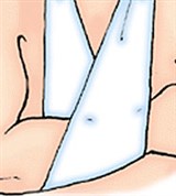 Иммобилизация верхней конечности с использованием косынки