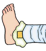 Иммобилизация нижней конечности