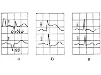 Инфаркт миокарда (электрокардиограмма)