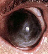 Исход язвы роговицы (1)