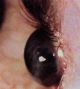 Исход язвы роговицы (2)