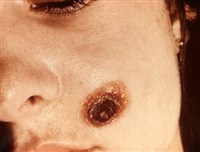 КАРБУНКУЛ НА ЛИЦЕ