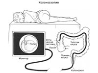 КОЛОНОСКОПИЯ (схема)