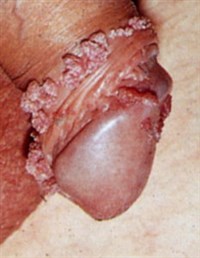 КОНДИЛОМЫ. ПОРАЖЕНИЕ ПОЛОВОГО ЧЛЕНА