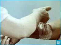 КРОВОТЕЧЕНИЕ ВЕНОЗНОЕ ПОВЕРХНОСТНОЕ (видео)