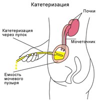 Катетеризация