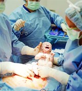 Кесарево сечение (появление ребенка)