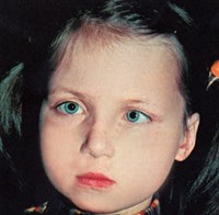 Косоглазие содружественное (1)