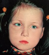 Косоглазие содружественное (2)