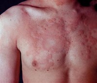 Крапивница