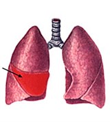Крупозная пневмония