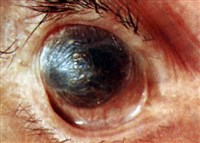 Ксероз конъюнктивы и роговицы