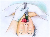 ЛАРИНГОСКОПИЯ (схема)