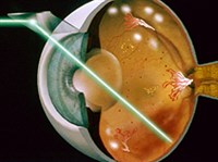 Лазерная хирургия (луч)