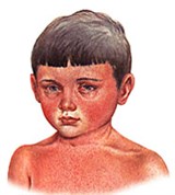 Лакунарная Ангина