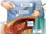 Лапароскопия (схема)