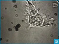 Лимфоциты (видео)