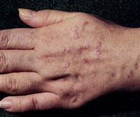 Лишай. высыпания на кисти
