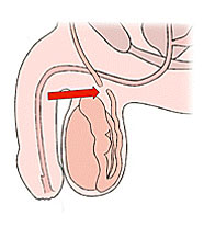 МУЖСКАЯ СТЕРИЛИЗАЦИЯ