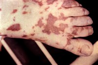 Менингококковая инфекция