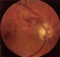 НАРУШЕНИЕ КРОВООБРАЩЕНИЯ В ЦЕНТРАЛЬНОЙ ВЕНЕ СЕТЧАТКИ (ветви вены)