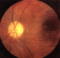 НЕВРИТ ЗРИТЕЛЬНОГО НЕРВА