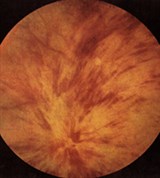 Нарушение кровообращения в центральной Вене сетчатки (основного ствола)