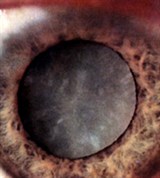 Незрелая старческая Катаракта