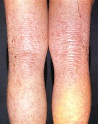 Нейродермит