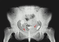 Непроходимость маточных труб