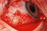 ОСТРЫЙ КОНЪЮНКТИВИТ