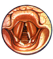 ОСТРЫЙ ЛАРИНГИТ