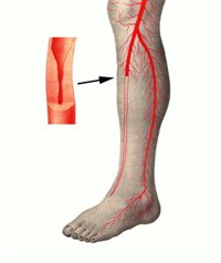 Облитерирующий Эндартериит