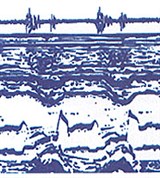 Одновременная регистрация фоно- и эхокардиограмм
