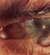 Ожог глаза (исход)