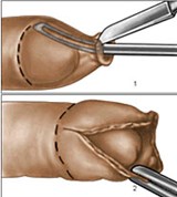 Оперативное лечение фимоза