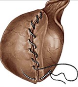 Операции при водянке яичка