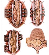 Опухоль из оболочки спинного мозга