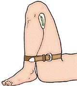 Остановка кровотечения в области голени