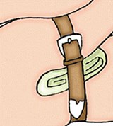 Остановка кровотечения в паховой области